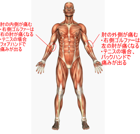 テニス肘ゴルフ肘で痛みが出る個所を説明した人体図