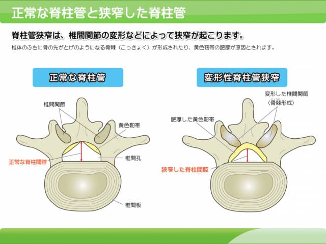 正常な脊柱管と狭窄した脊柱管