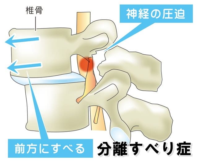 分離すべり症の図解