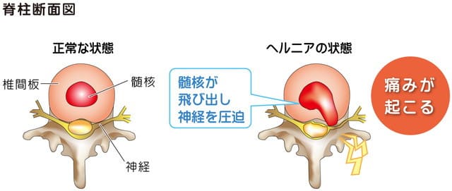 脊柱断面図