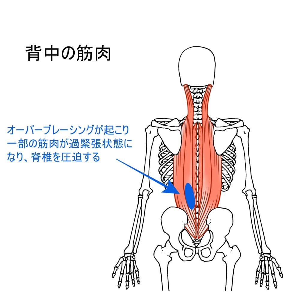 脊柱を圧迫する説明の人体図