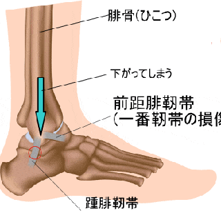 腓骨が下がる図解