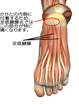 足裏の痛くなる箇所のイラスト