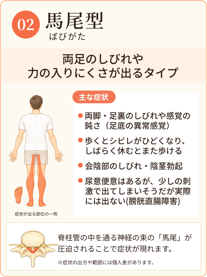 馬尾型