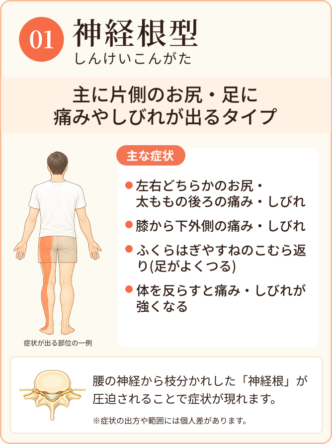 神経根型