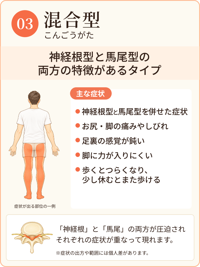 混合型